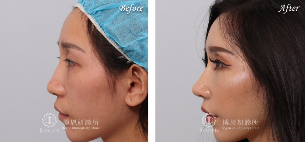 博恩妍診所張簡醫師晶亮瓷清除自體肋軟骨異體真皮鼻重修費用